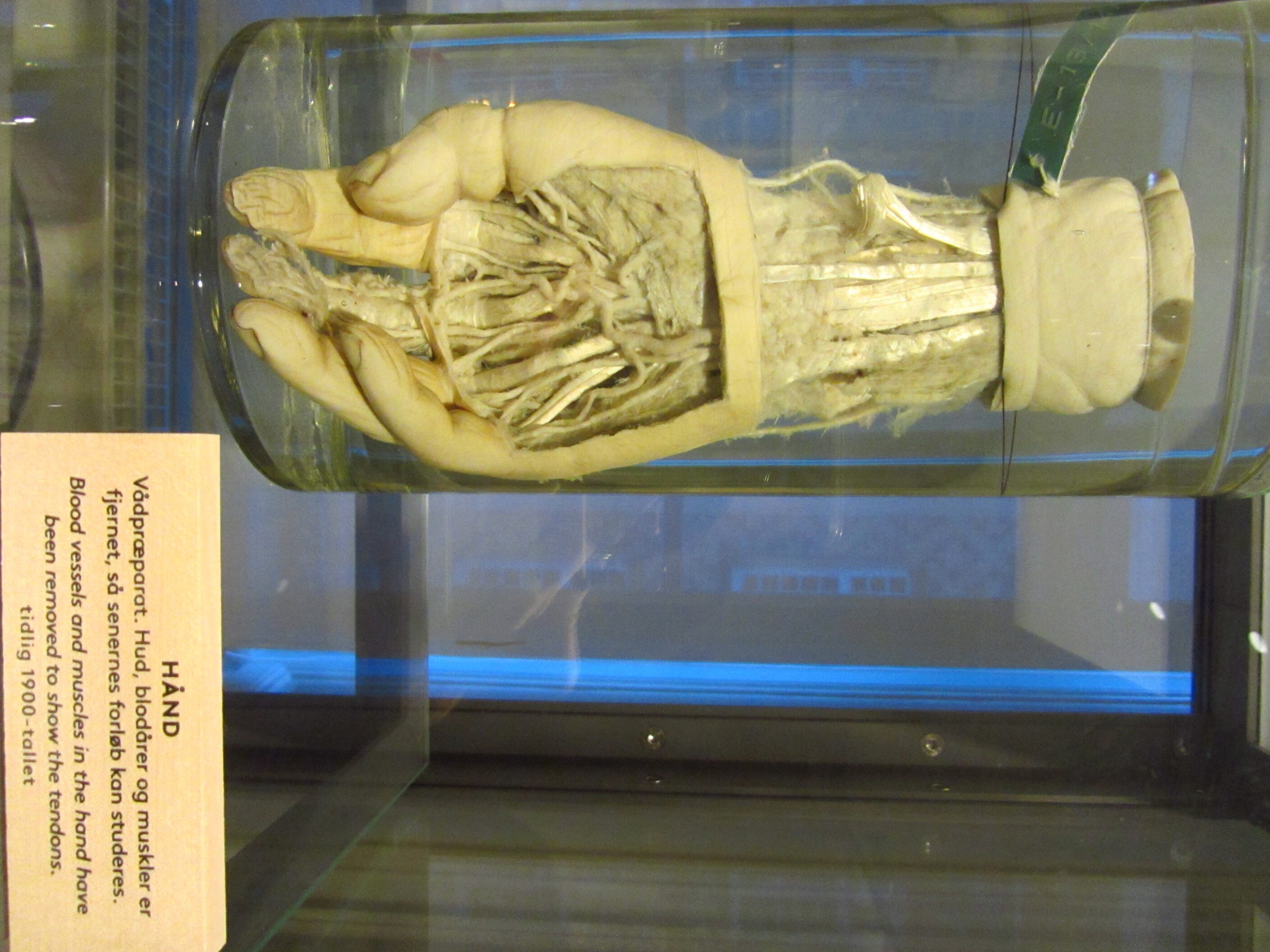 Photo 3: Left: Tendons of a hand, early 20th century.